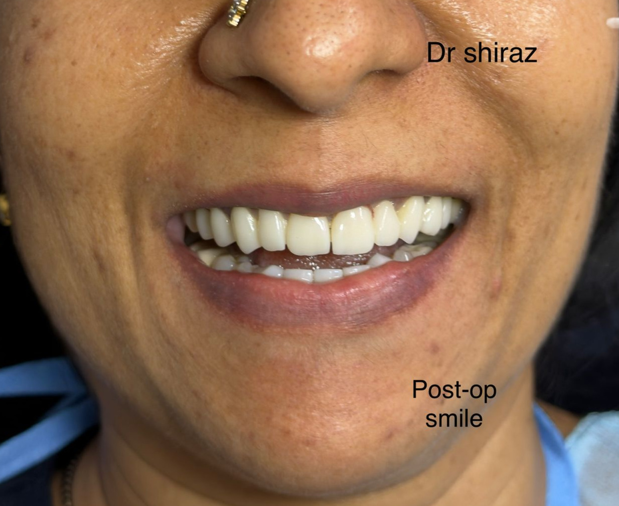 After Teeth Whitening