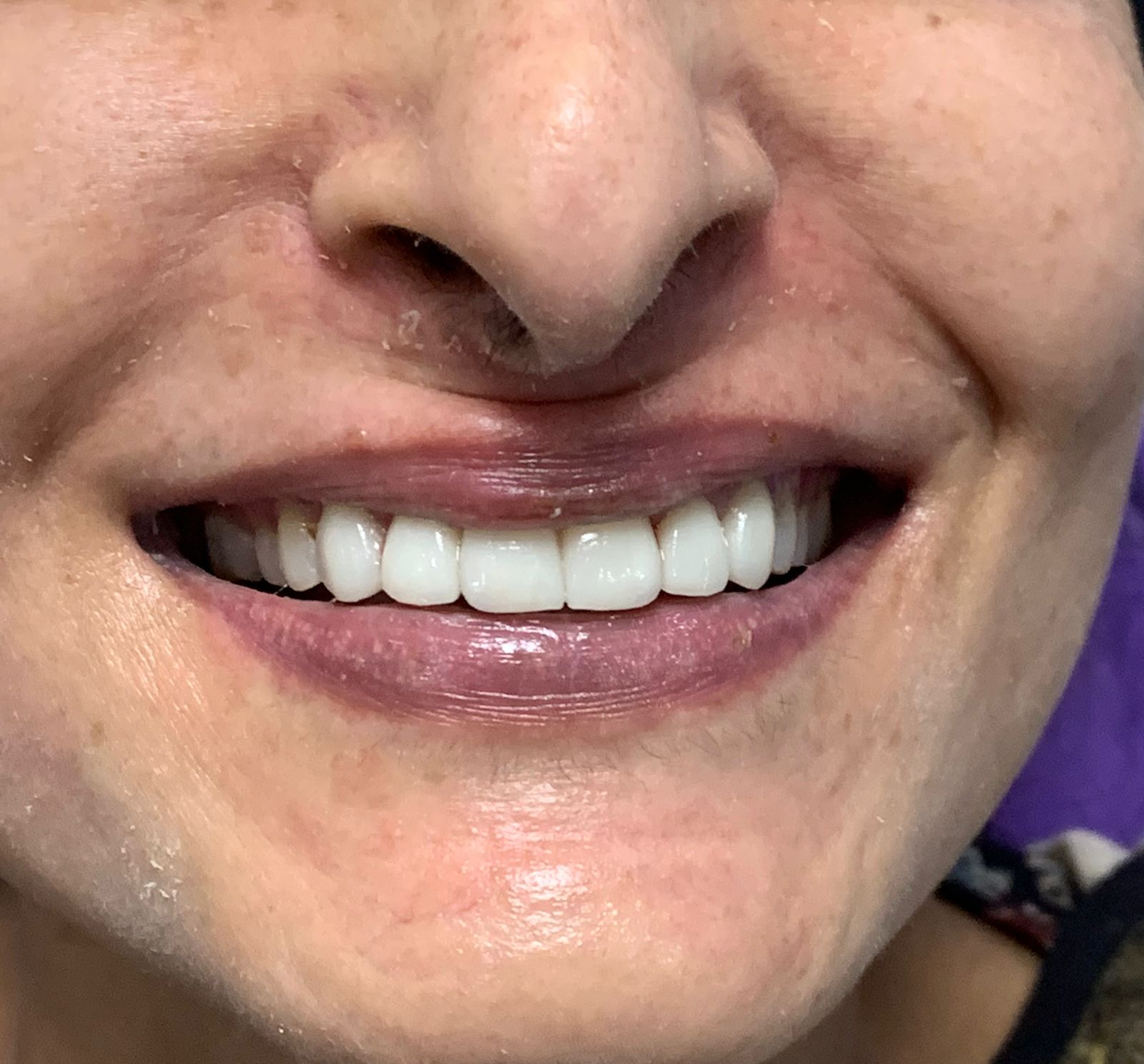 After Braces