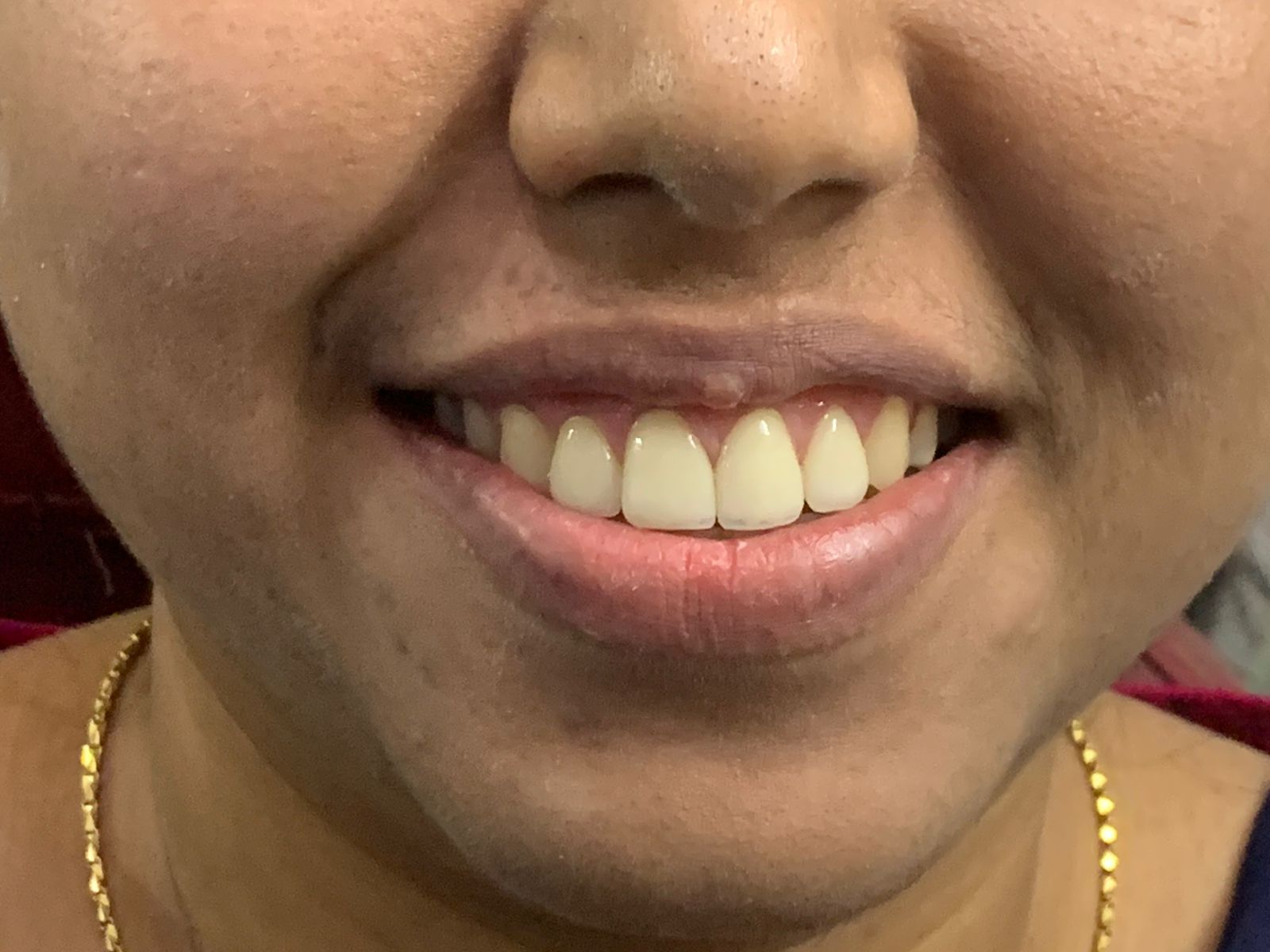 After Smile Makeover