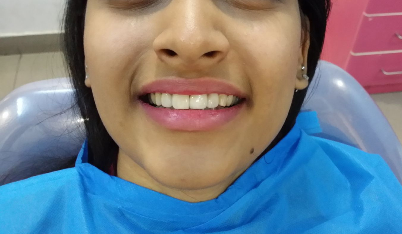 After Dental Implant