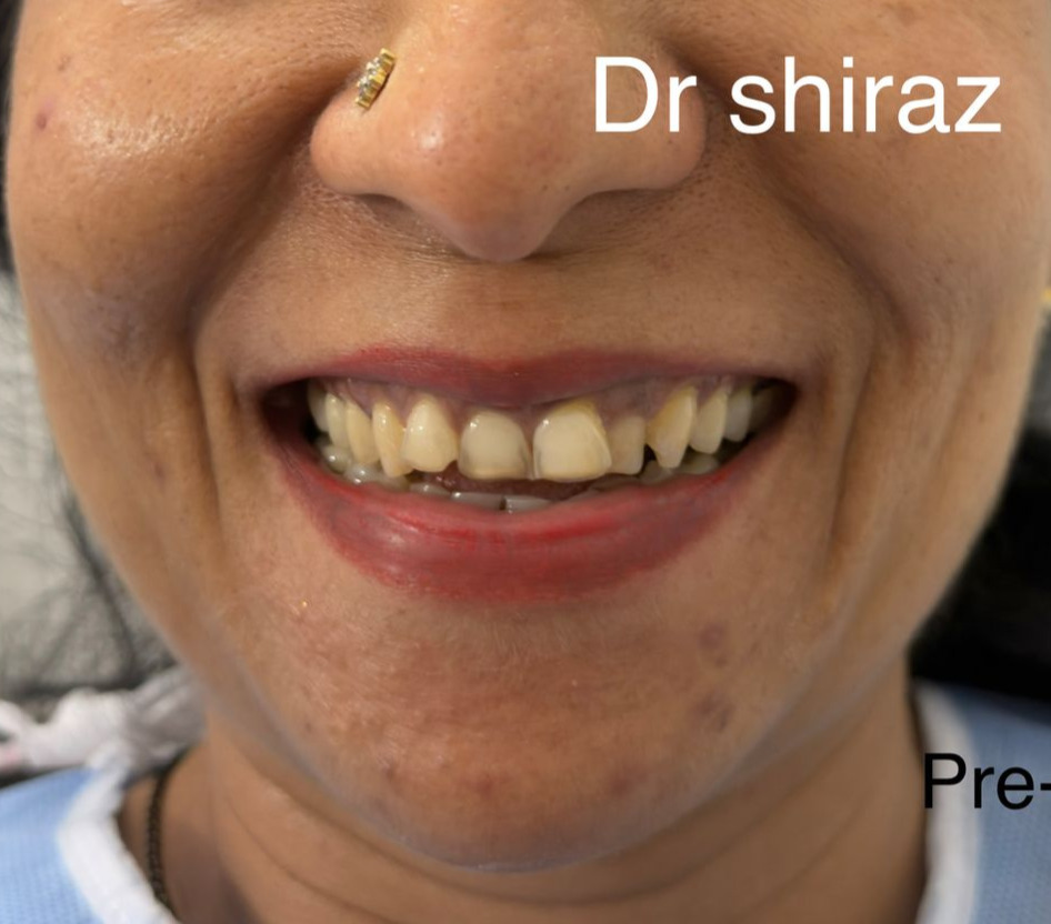 Before Teeth Whitening
