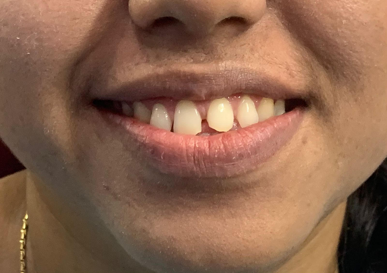 Before Smile Makeover