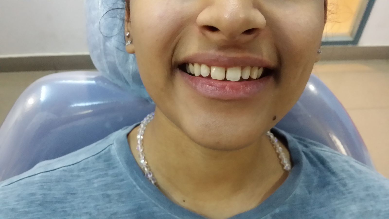 Before Dental Implant