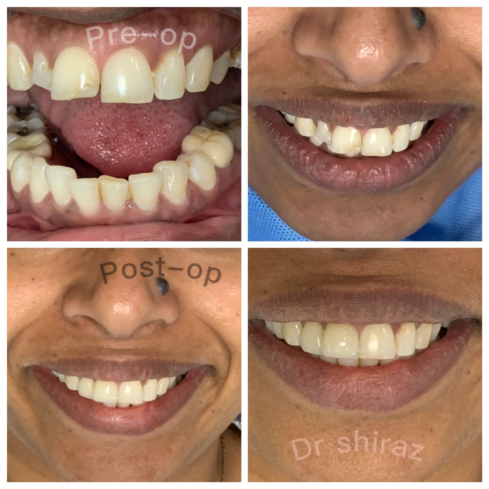 Veneers Treatment