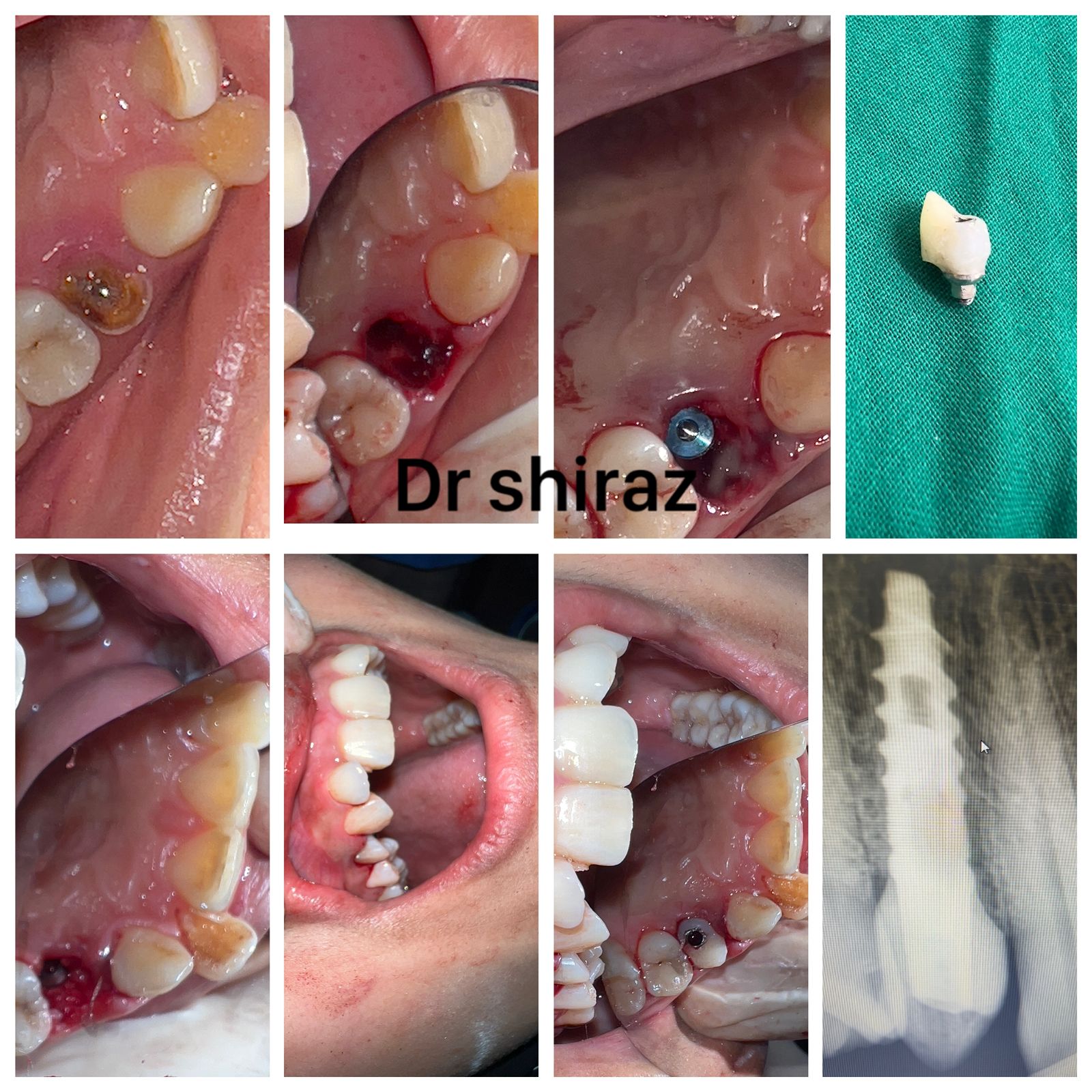 Gum Treatment